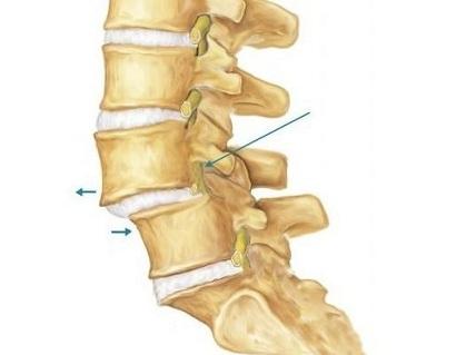 腰椎滑脱——导致腰腿疼的一个疾病之一