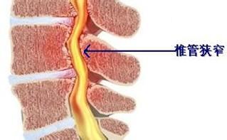 腰椎间盘突出和椎管狭窄有什么区别？