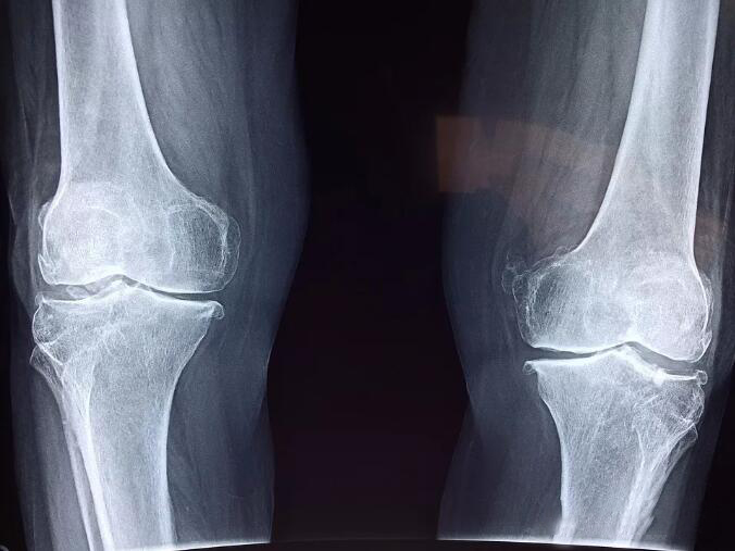 膝关节退行性病变是怎么回事？有哪些症状呢？