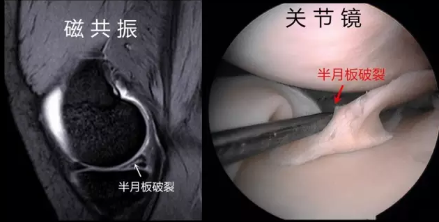 膝关节半月板影像