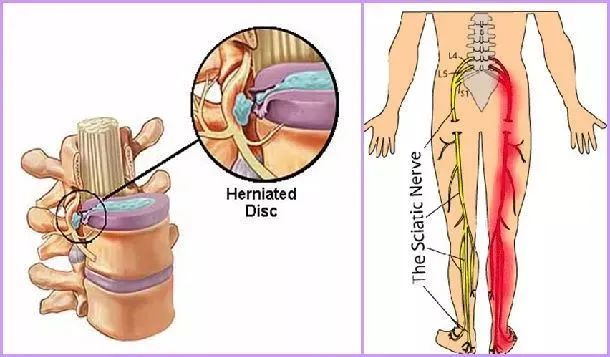 腰椎间盘突出为什么会引起腿痛或腿麻