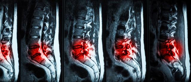 脊椎病有哪些？会对人体造成哪些影响？